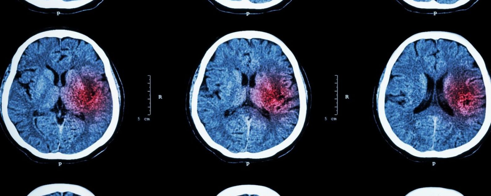 Tomografía computarizada del cerebro que muestra una hemorragia cerebral